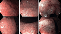 MAPS II Новые Европейские рекомендации по ведению пациентов с предраковыми изменениями в желудке